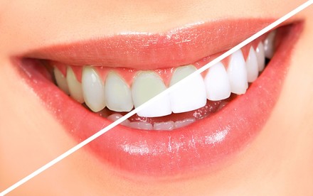 Cosmetic Dentistry Flagstaff, AZ