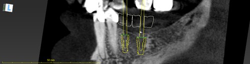 Oasis Dental Care Implants 5