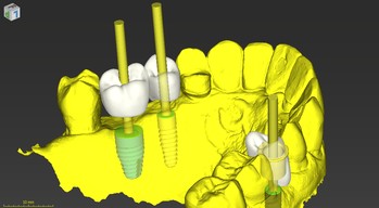 Oasis Dental Care Implants 4