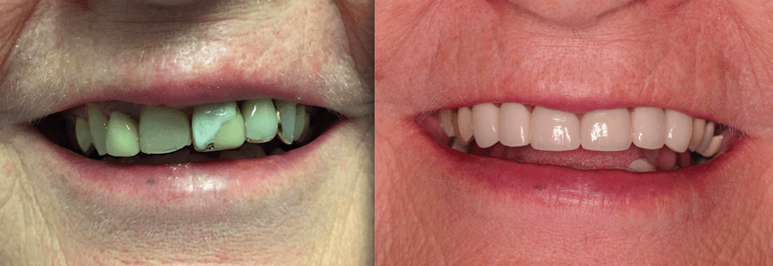 Before and After Bridges - Oasis Dental Care - Flagstaff, Az
