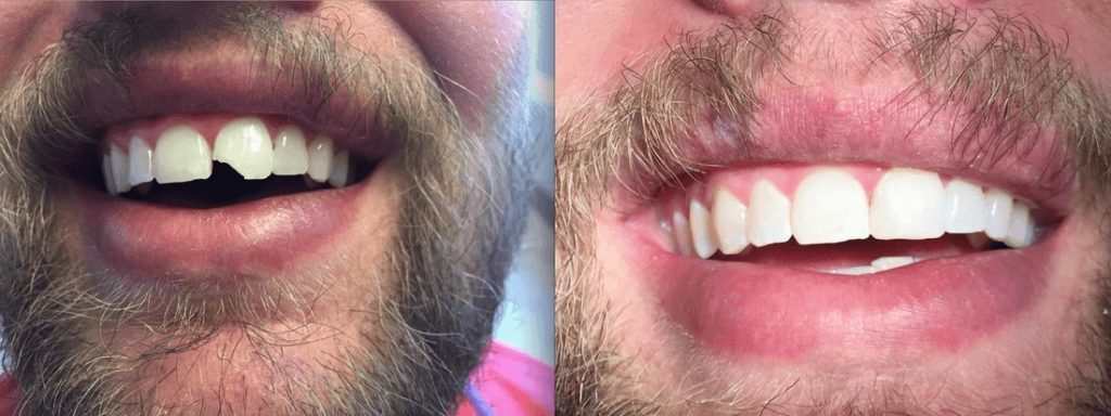 Tooth Bonding Before and After Oasis Dental Care