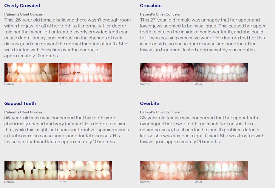 Overbite Treatment Flagstaff AZ- Oasis Dental Care