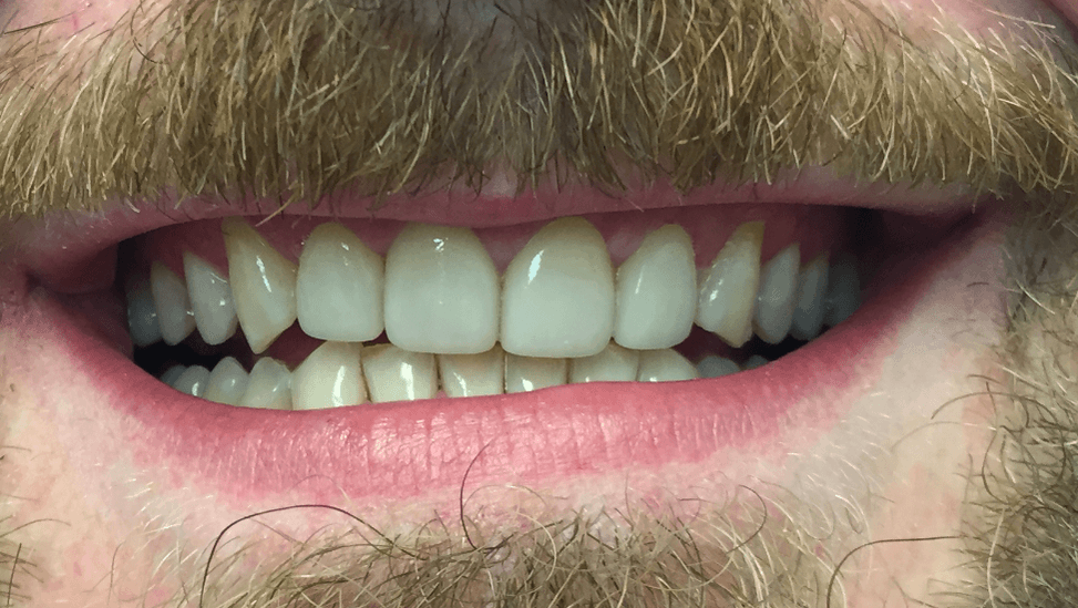 After Veneers - Oasis Dental Care - Flagstaff, AZ
