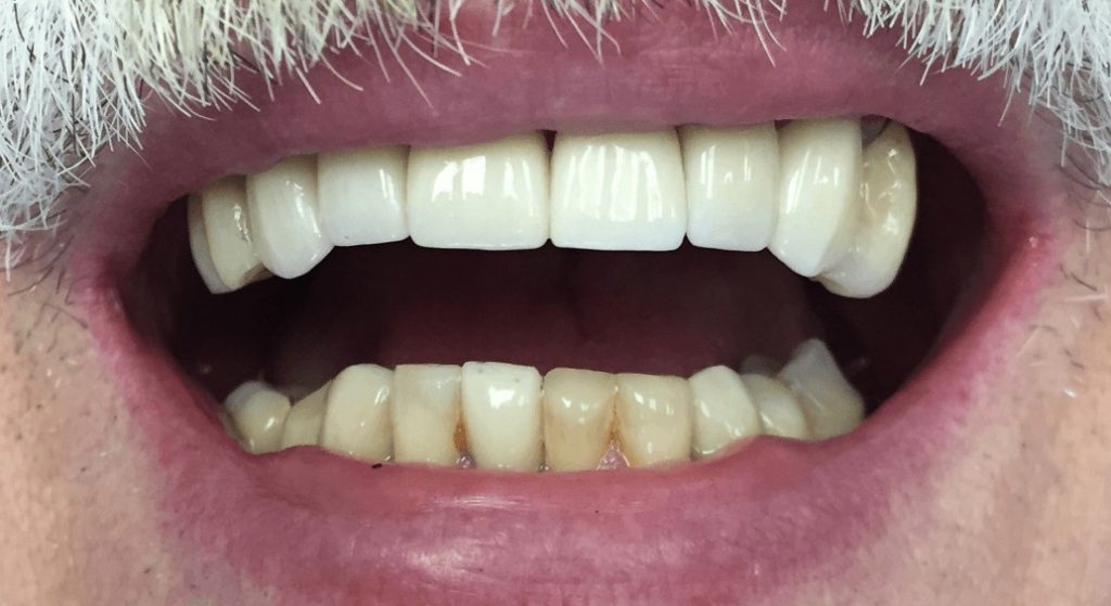 Crowns & Implant After - Oasis Dental Care - Flagstaff, AZ