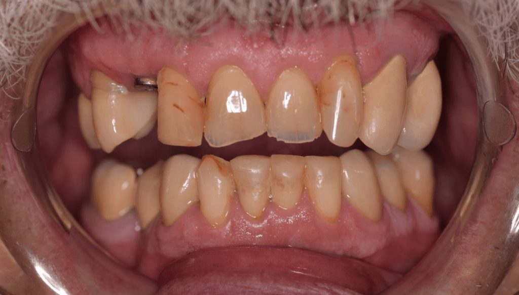 Crowns & Implant Before - Oasis Dental Care - Flagstaff, AZ