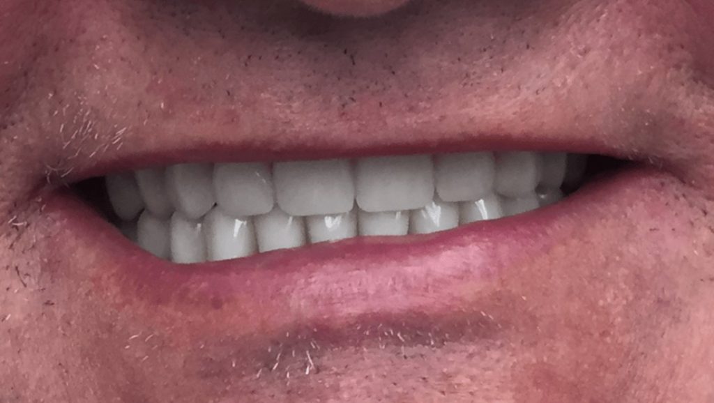 After Dentures - Oasis Dental Care- Flagstaff, AZ