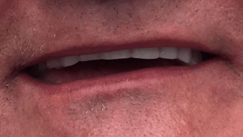 Before Dentures - Oasis Dental Care - Flagstaff, AZ