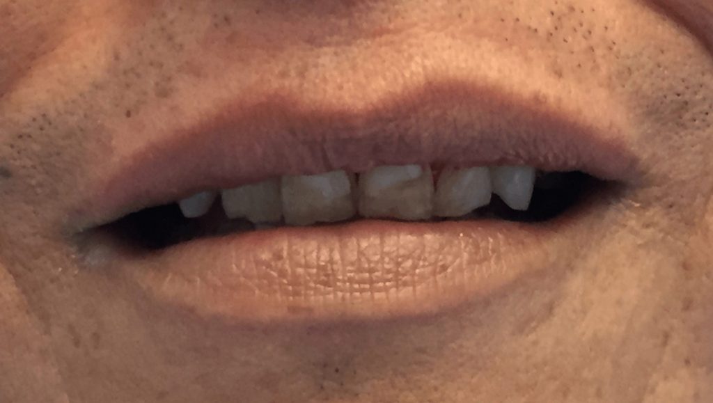 Crowns Before - Oasis Dental Care - Flagstaff, AZ