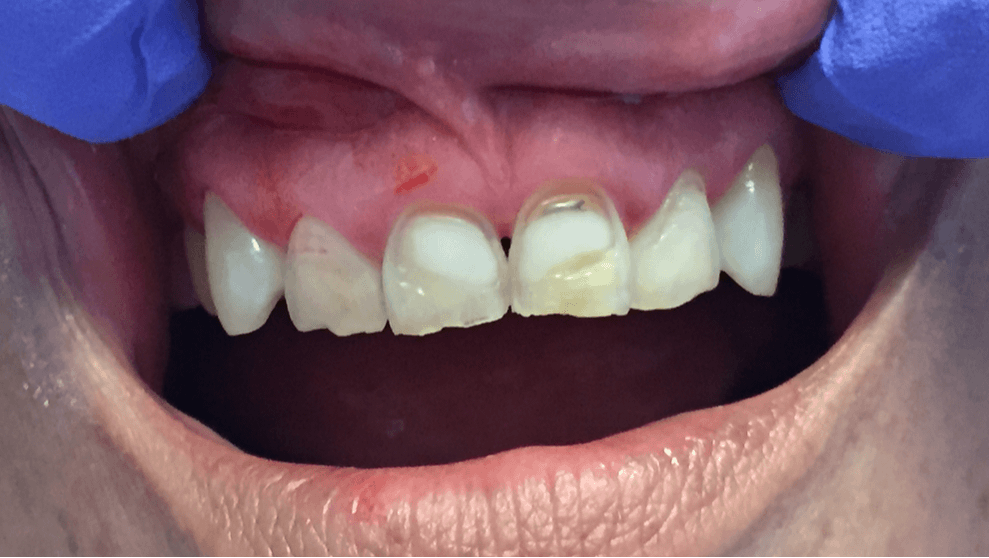 Before Crowns - Oasis Dental Care - Flagstaff, AZ