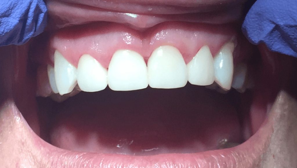Completed Dental Bridge - Oasis Dental Care - Flagstaff AZ