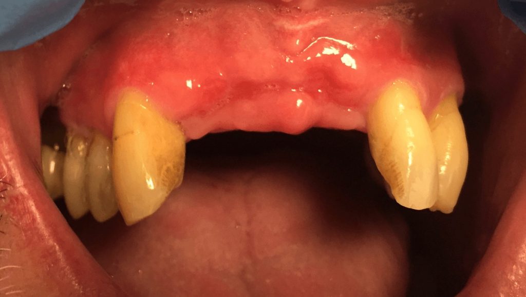 Before Implant Bridge - Oasis Dental Care - Flagstaff, AZ