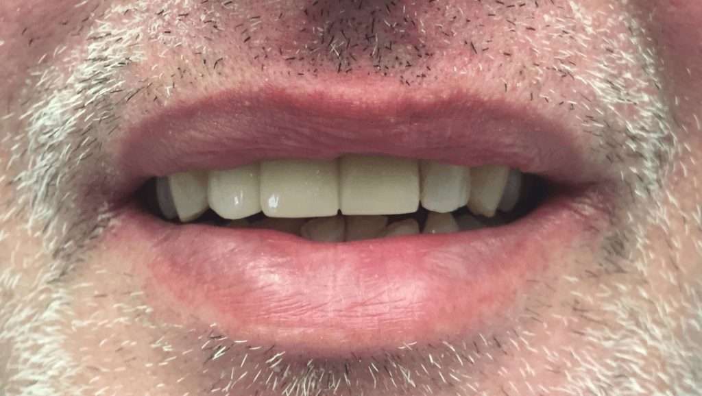 After Dental Bridge - Oasis Dental Care - Flagstaff, AZ