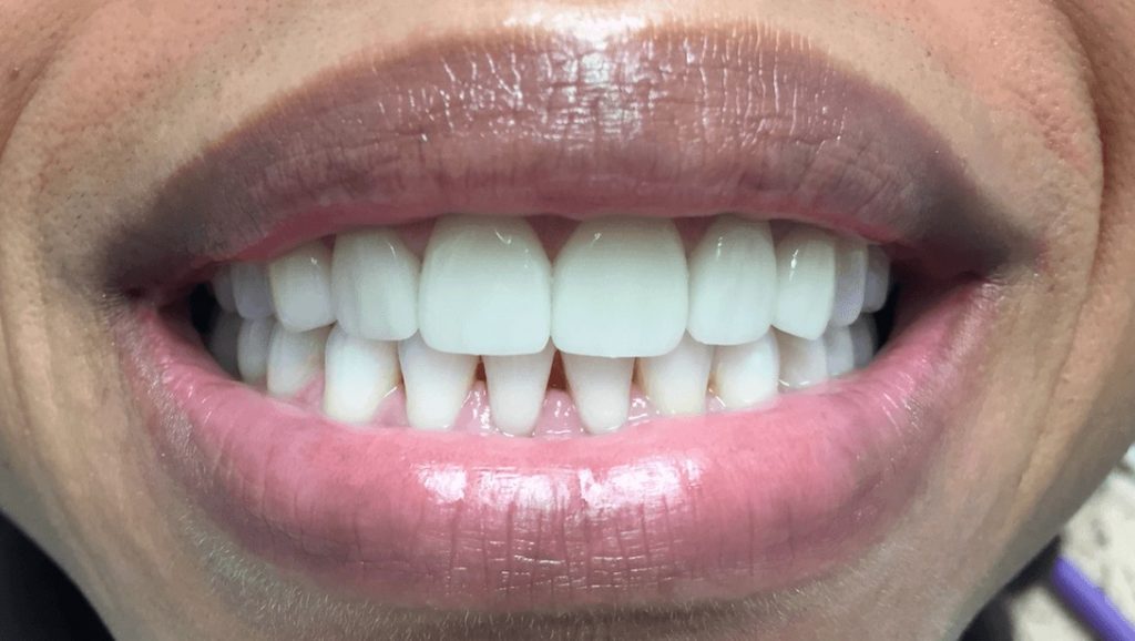 After-gum-grafting-and-veneers-oasis-dental-care-flagstaff
