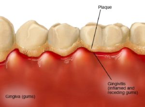 Gingivitis