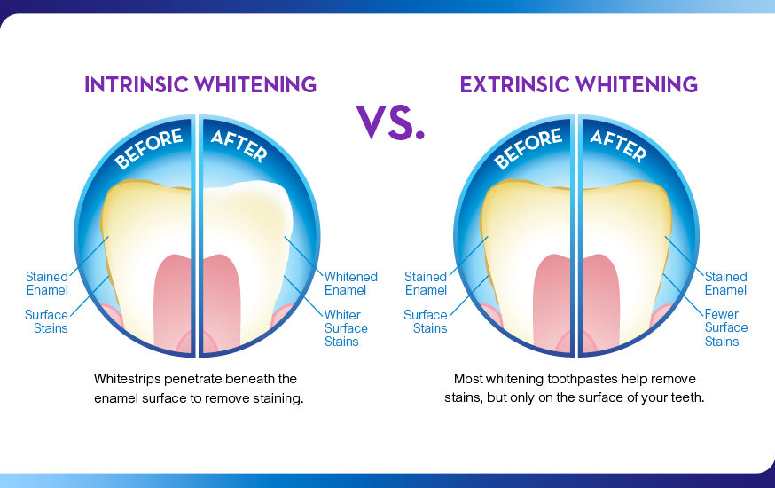 Why are your teeth sensitive after whitening