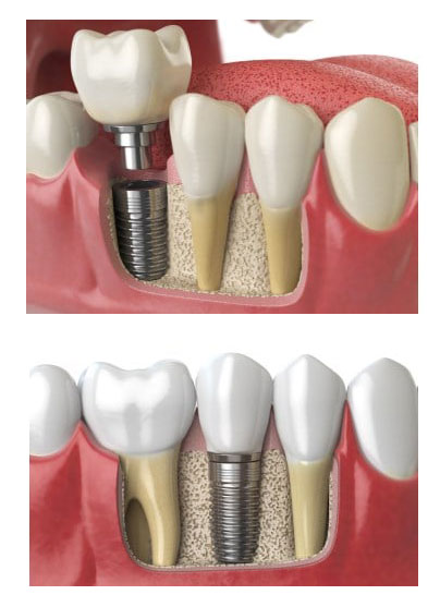 bone-grafting - Oasis Dental Care - Dentist In Flagstaff